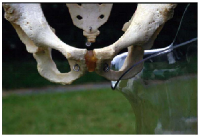 Ischial containment socket on a pelvis model, anterior view