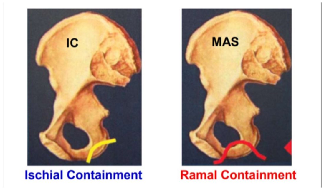 Pelvis models comparing ischial containment with MAS ramal containment