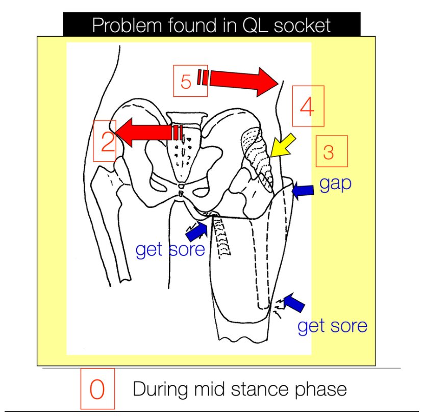 Diagram of the femur abducting inside a QL socket with gaps and pressure areas